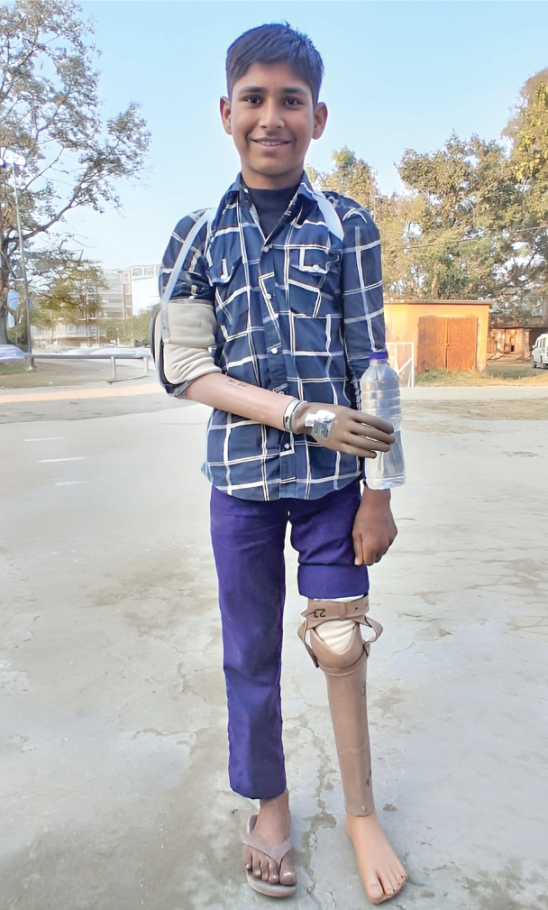  Ravi, a 16-year-old from Basantpur village in the Balrampur district of Uttar Pradesh who lost his hand and leg in a railway accident at the age of two, with the prosthetic limbs he received through the initiative 